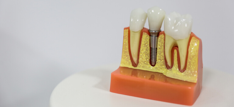 インプラントと歯周病治療の関連