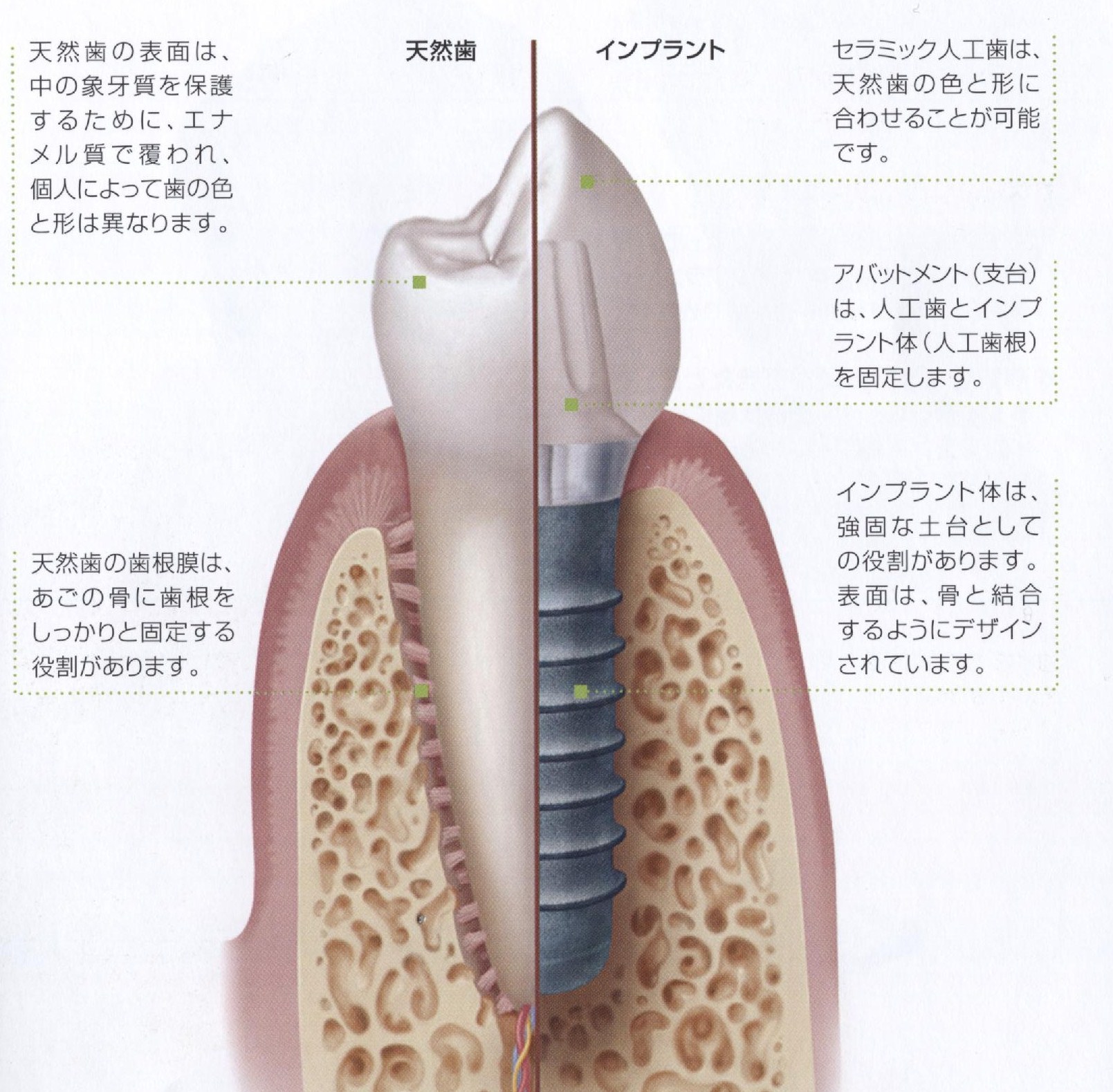 インプラント治療について | 【公式】関口デンタルオフィス埼玉