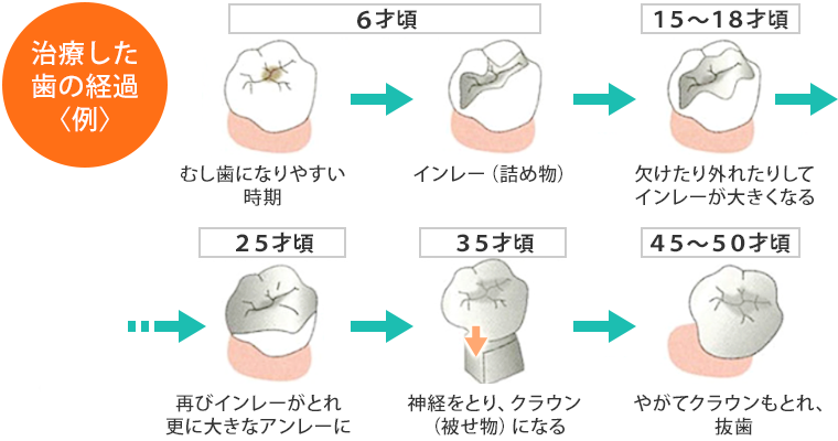 治療した歯の経過例