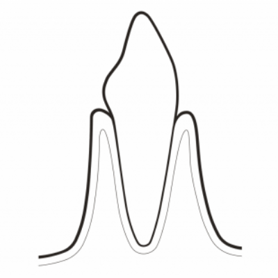 健康な歯質の維持